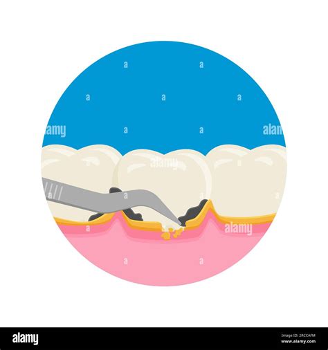 Teeth scaling, dental plaque removal for cleaning and health Stock Vector Image & Art - Alamy