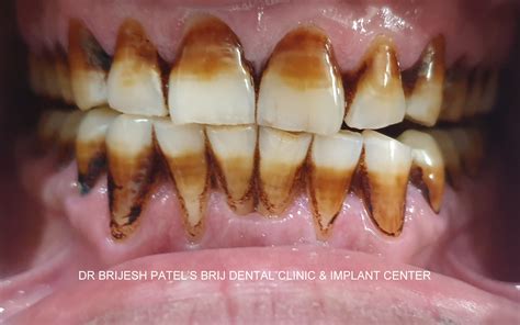 Teeth whitening in Ahmedabad Gujarat India | Laser Teeth Whitening in Ahmedabad