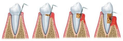 Image result for Tooth Mobility Problem