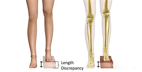 Measure Leg Length Discrepancy 的图像结果