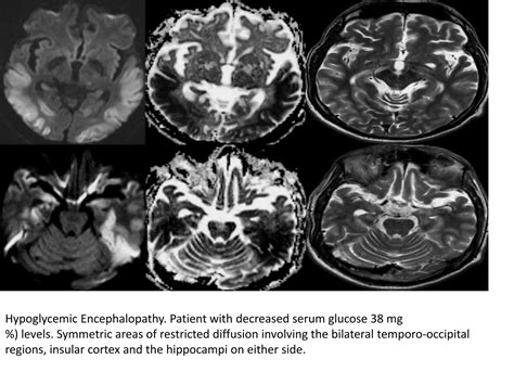 Amol toxic and metabolic encephalopathy syndrome | PPT