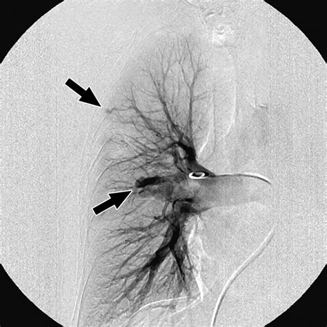 MR Angiography for Detection of Pulmonary Arteriovenous Malformations in Patients with ...