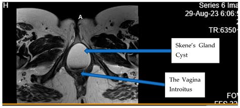 Symptomatic Giant Skene’s Gland Cyst During Second Trimester Pregnancy ...