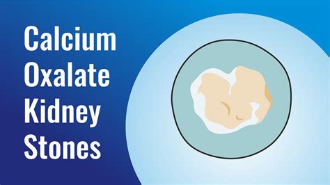 Calcium Oxalate Kidney Stones – RIRS INDIA