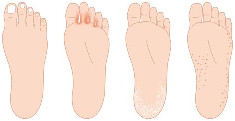 For Seniors: Comprehensive Guide to Athlete's Foot Between Toes - SR Parents