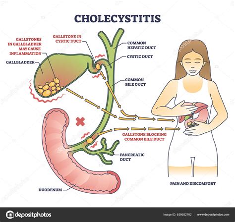 Modelo De Vesicula Biliar Rotulado Fígado, Vesícula Biliar E