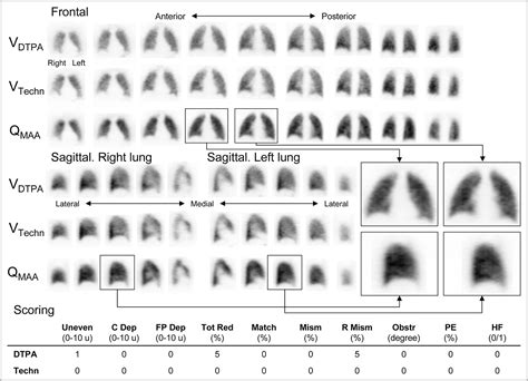 Ventilation–Perfusion SPECT with 99mTc-DTPA Versus Technegas: A Head-to ...
