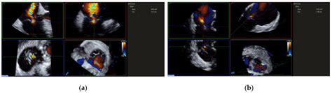 Real-Time Monitoring and Step-by-Step Guidance for Transcatheter ...