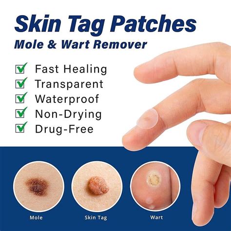 Skin-Safe Wart Removal Patch for Moles, Calluses, India | Ubuy