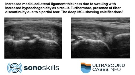 This article describes the reliability of MSK ultrasound in medial collateral ligament injury ...