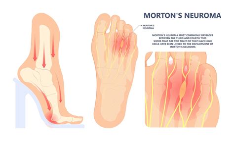 Morton’s Neuroma: A Step Towards Comfort Without Compromising Style - Podiatry Foot Doctor in St ...