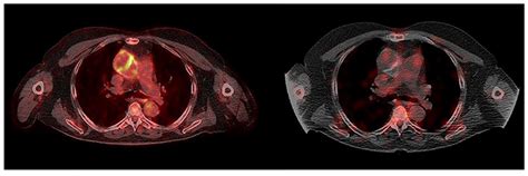 A Head-to-Head Comparison Between [18F]Fluorodeoxyglucose ([18F]FDG ...