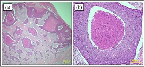 Diagnosis and Management of Porocarcinoma