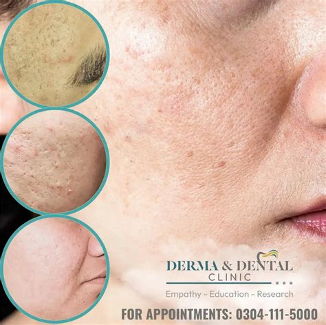 Acne Scars and Unveil Your Radiant Skin: Derma & Dental Clinic's – Derma.pk