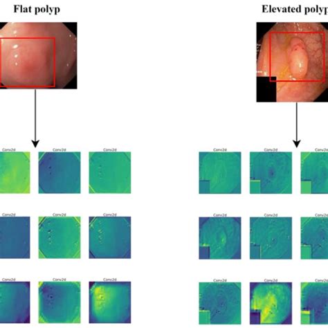 Image result for Polyp Detection Device