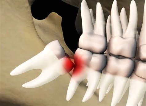 ¿Cuándo es necesario quitar las muelas del juicio? - El Odontólogo