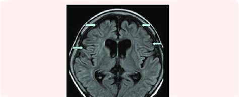 Image result for Diffuse Atrophy