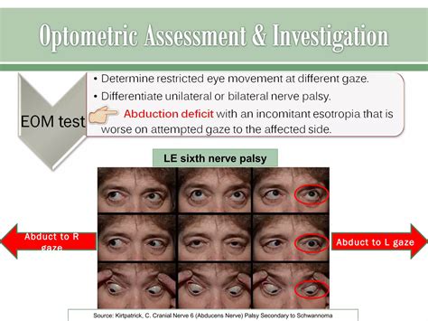 Sixth nerve palsy