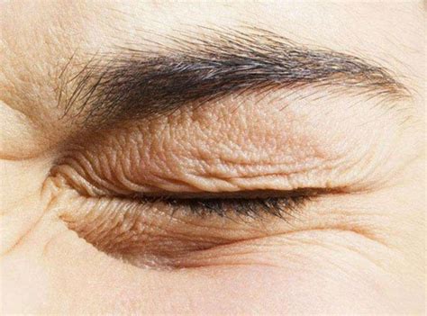 眼周皱纹祛除的3种方法及优劣势比较 - 知乎