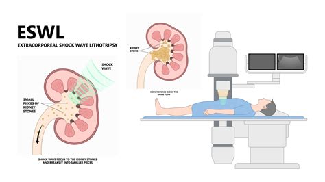 ESWL Shock Wave Lithotripsy For Kidney Stones | North Texas | UPNT