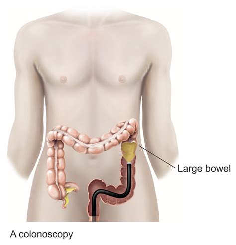 Image result for Position Colonoscopy Procedure