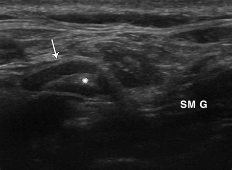 Neck Ct Scan Multiple Necrotic Cervical Lymph Nodes The Biggest