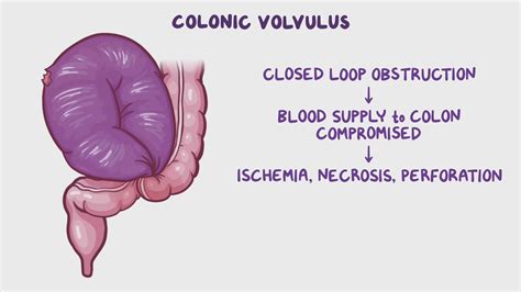 Video: Colonic volvulus: Clinical sciences | Osmosis