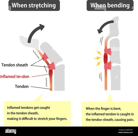 Trigger finger causes and symptoms illustration / English (with explanation texts Stock Vector ...