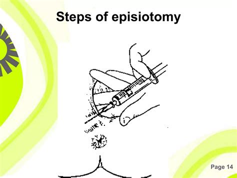Episiotomy | PPTX