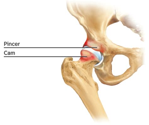 FAI: All About Femoral Acetabulum Impingement - Markow Training Systems
