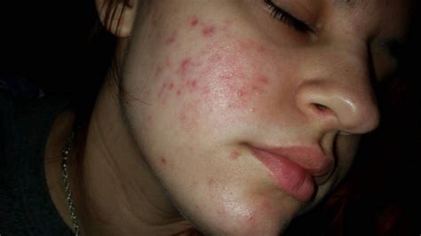 Acne scars and marks – Hyperpigmentation – red/dark marks – Acne.org Forum