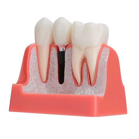 Buy faruijie Dental im model, crown bridge teeth model, removable 4-way ...