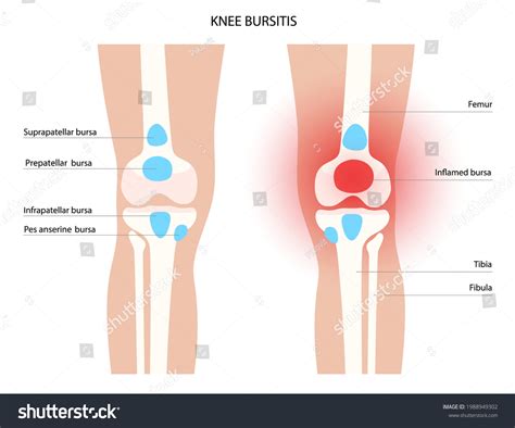 Knee Bursitis Inflammation Inflamed Bursa Human Stock Vector (Royalty ...