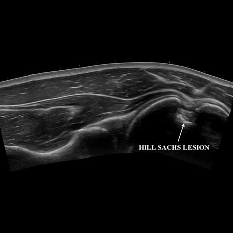 Case nr 2 in the shoulder quiz: The typical Hill Sachs Lesion is due to ...
