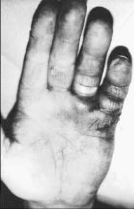 Image result for Exploding Orange Hand Injury