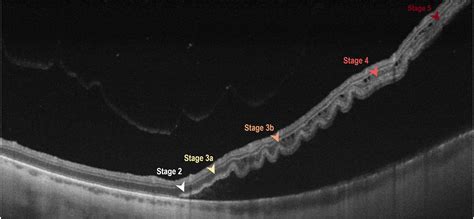 Morphologic Stages of Rhegmatogenous Retinal Detachment Assessed Using Swept-Source OCT ... - layers of retina oct