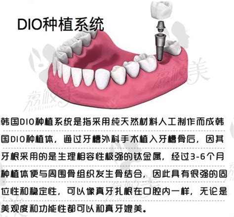 韩国植体dio属于高低哪个档次?一文看懂其种植牙系统优缺点 - 贝色口腔