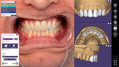 Digital Smile Designing Delhi India Smile Correction Cost Delhi India