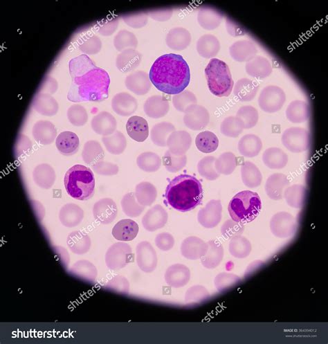 Mix Cells.Malaria Pigment,Atypical Lymphocyte,Monocyte.Blood Smear Is Often Used As A Follow-Up ...