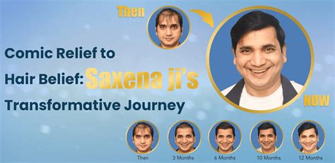 Beard hair Transplant in Delhi, India | Cost, Procedure & Best Clinics