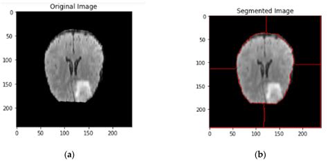 Brain Tumor Segmentation of MRI Images Using Processed Image Driven U ...