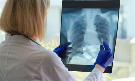 GLP-1 receptor agonists and SGLT-2 inhibitors reduce COPD exacerbations ...