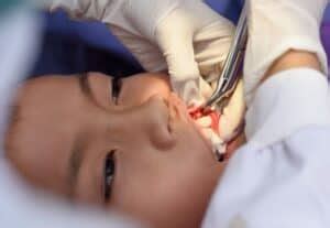 Image result for Basic Tooth Extraction