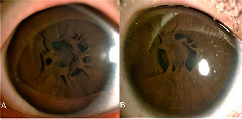 A rare case report of bilateral persistent pupillary membranes: Surgical intervention restoring ...