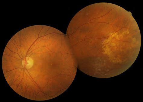 Image result for Problem Blob Eye Out