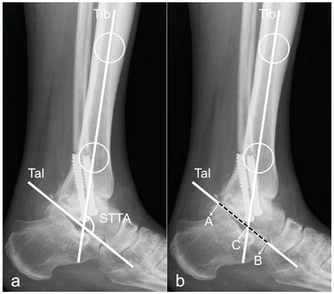 Labeled Lateral Ankle Xray at Albert Glover blog