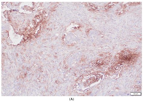 A Prospective Study on the Roles of the Lymphocyte-to-Monocyte Ratio ...