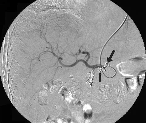Efficacy of the Left Gastric Artery as a Route for Catheterization of the Right Gastric Artery | AJR