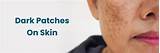 كيفية علاج البقع الداكنة على الجلد والوقاية منها