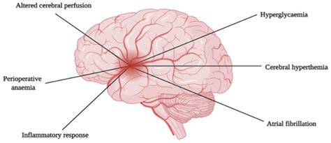 Contemporary Neuroprotection Strategies during Cardiac Surgery: State ...